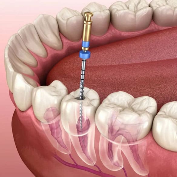 root-canal-treatment